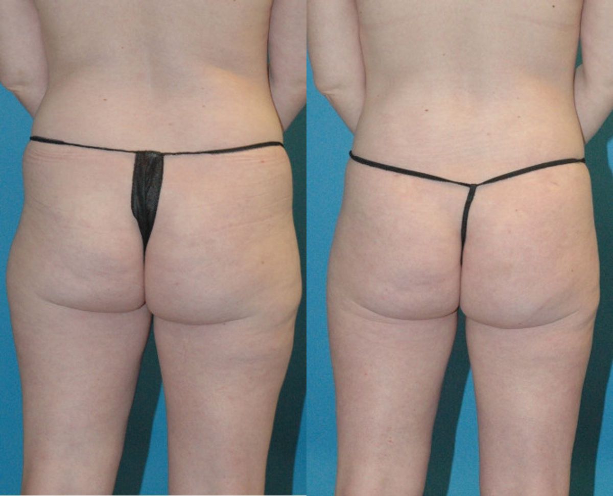 Liposuction #7 - Before and After