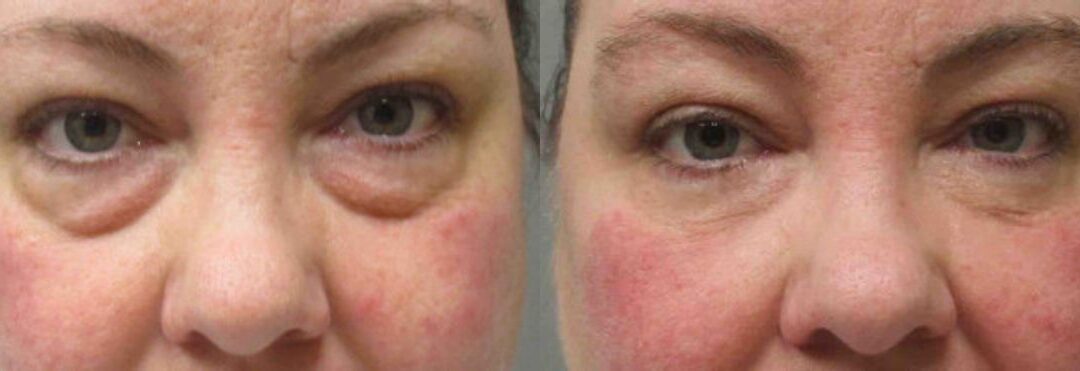 Lower Blepharoplasty
