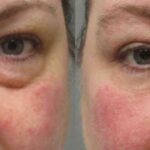 Lower Blepharoplasty - Before and After