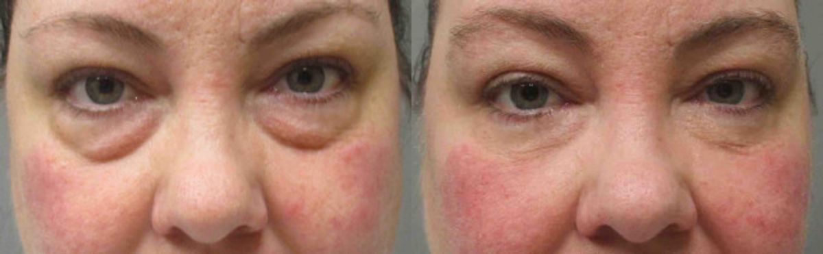 Lower Blepharoplasty - Before and After