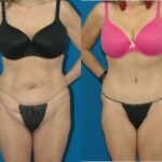 Lower Body Lift #2 - Before and After