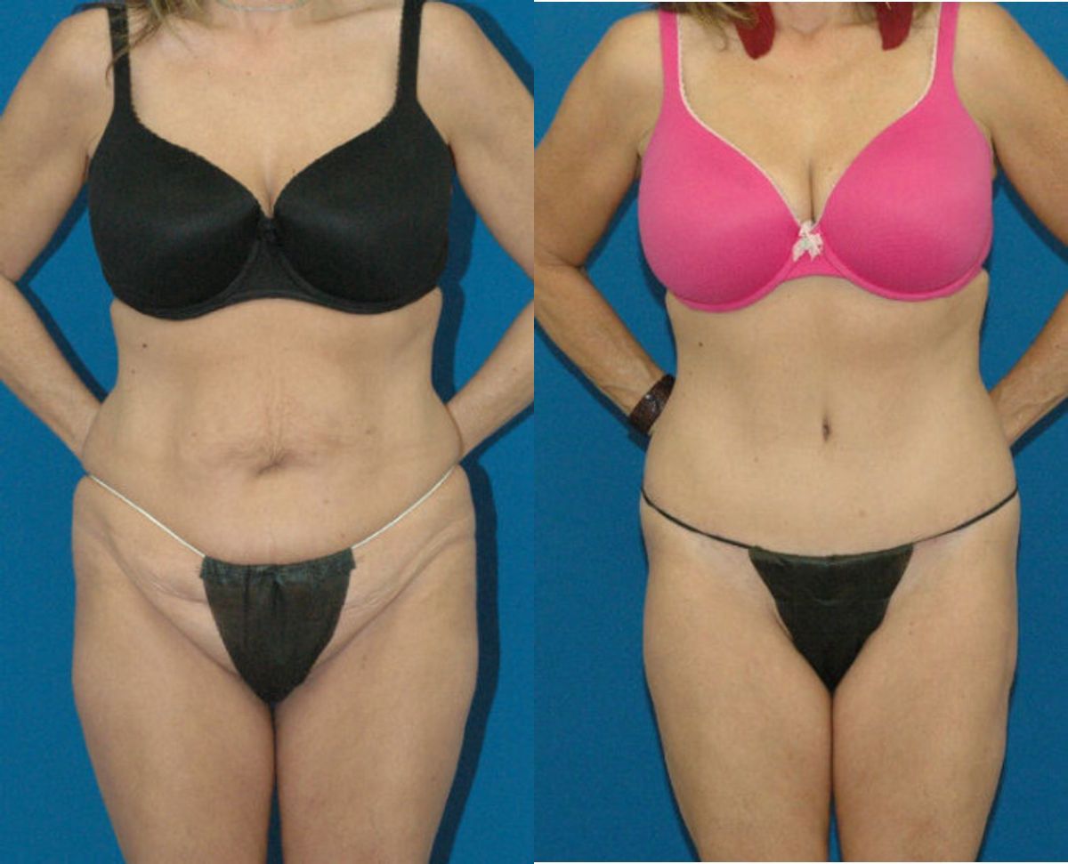 Lower Body Lift #2 - Before and After