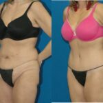 Lower Body Lift #2 - Before and After