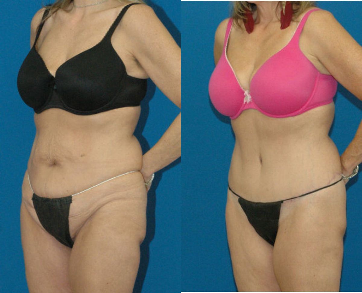 Lower Body Lift #2 - Before and After