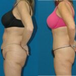 Lower Body Lift #2 - Before and After