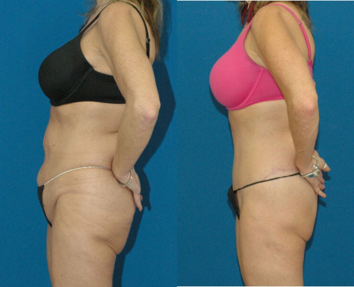Lower Body Lift #2 - Before and After