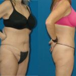 Lower Body Lift #2 - Before and After