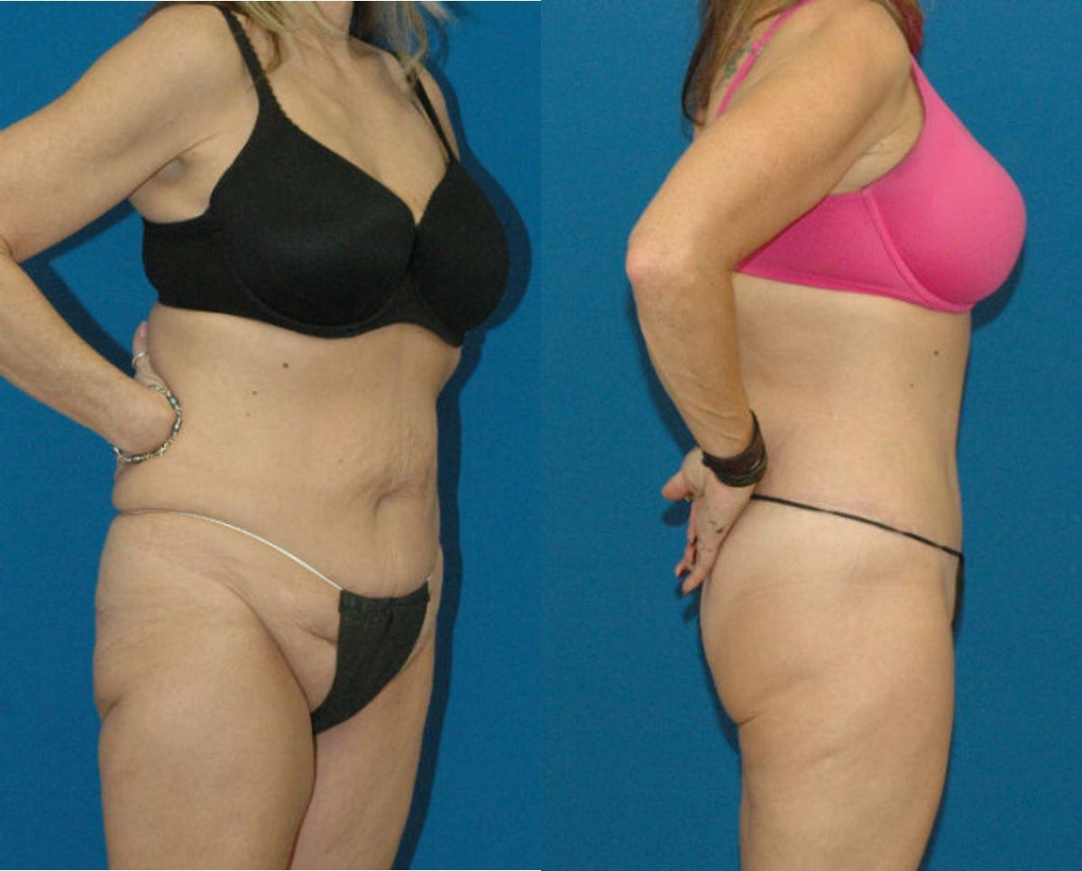 Lower Body Lift #2 - Before and After