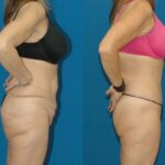 Lower Body Lift #2 - Before and After