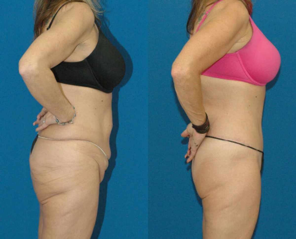 Lower Body Lift #2 - Before and After
