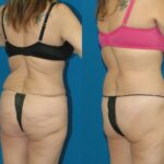 Lower Body Lift #2 - Before and After