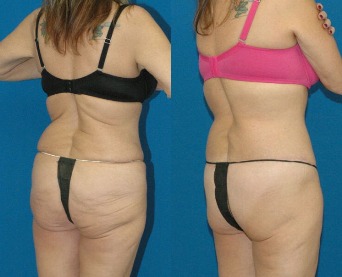 Lower Body Lift #2 - Before and After