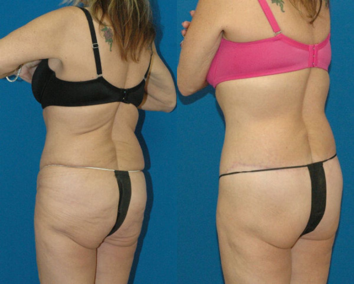 Lower Body Lift #2 - Before and After