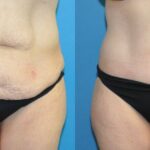 Lower Body Lift #3 - Before and After