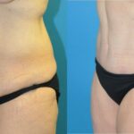 Lower Body Lift #3 - Before and After