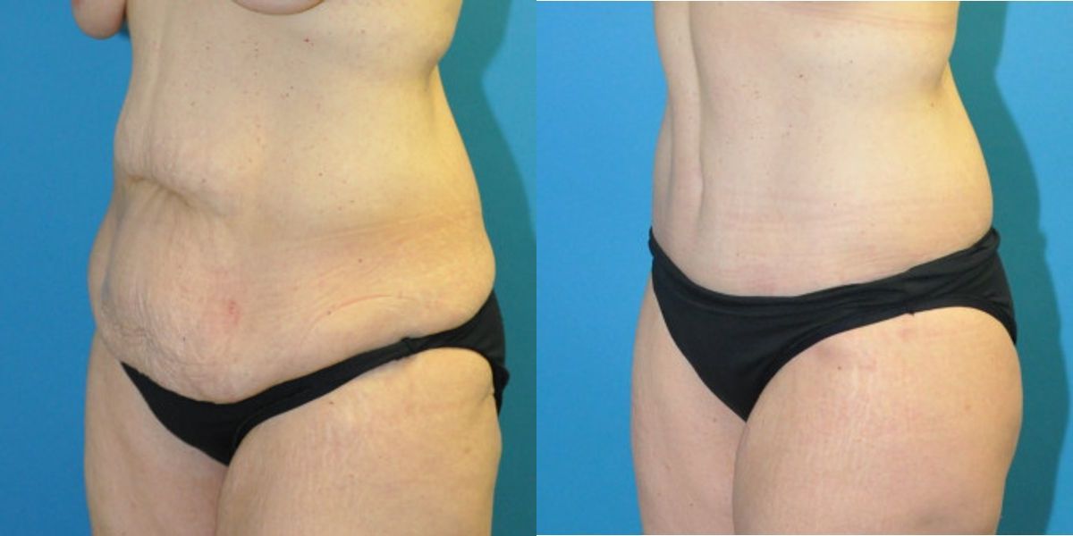 Lower Body Lift #3 - Before and After