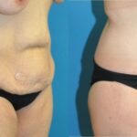 Lower Body Lift #3 - Before and After