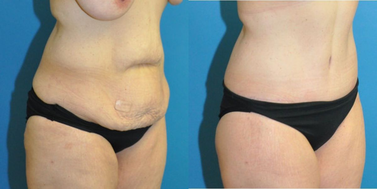 Lower Body Lift #3 - Before and After