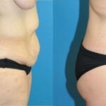 Lower Body Lift #3 - Before and After