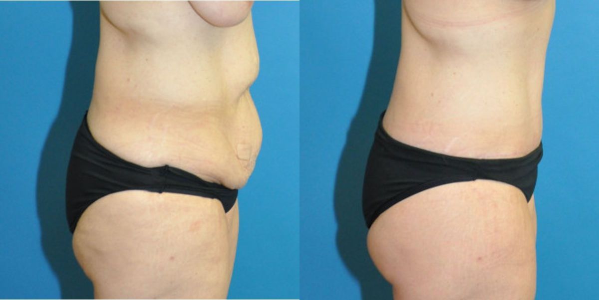 Lower Body Lift #3 - Before and After