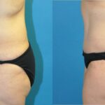 Lower Body Lift #3 - Before and After