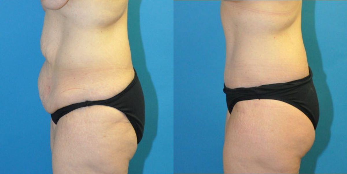 Lower Body Lift #3 - Before and After