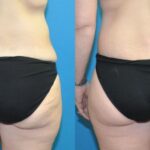 Lower Body Lift #3 - Before and After