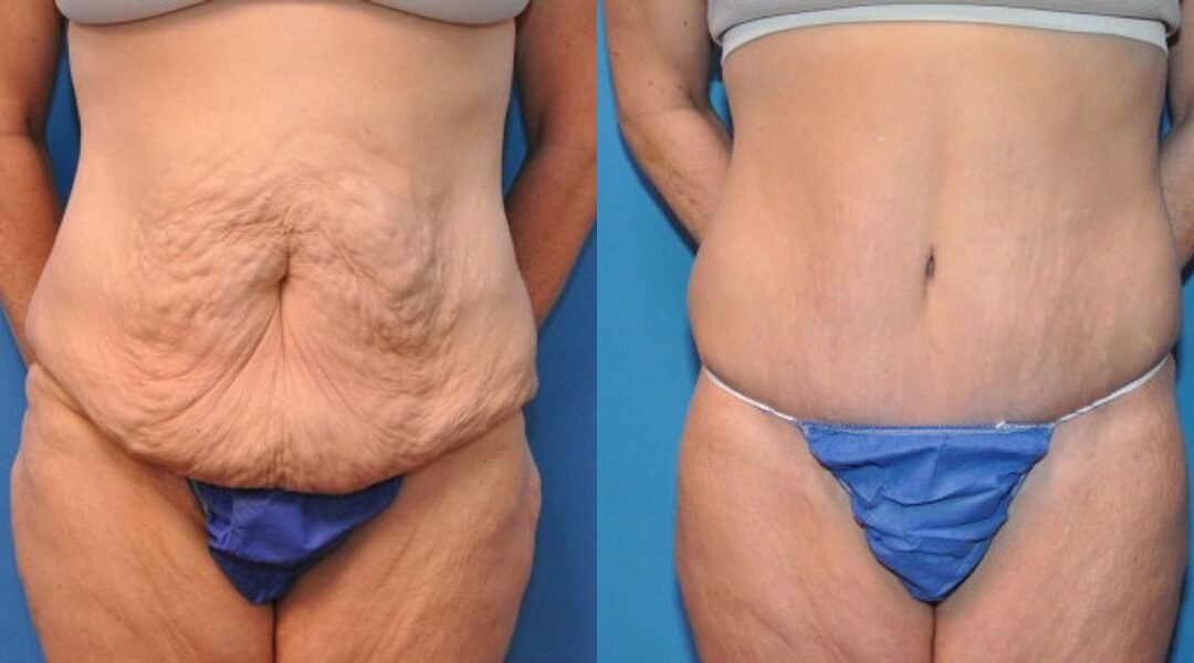 Lower Body Lift #4