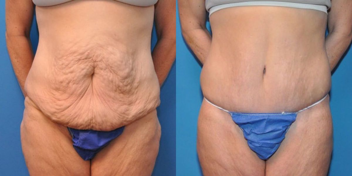 Lower Body Lift #4 - Before and After