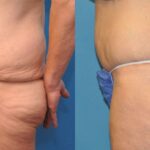 Lower Body Lift #4 - Before and After