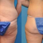Lower Body Lift #4 - Before and After
