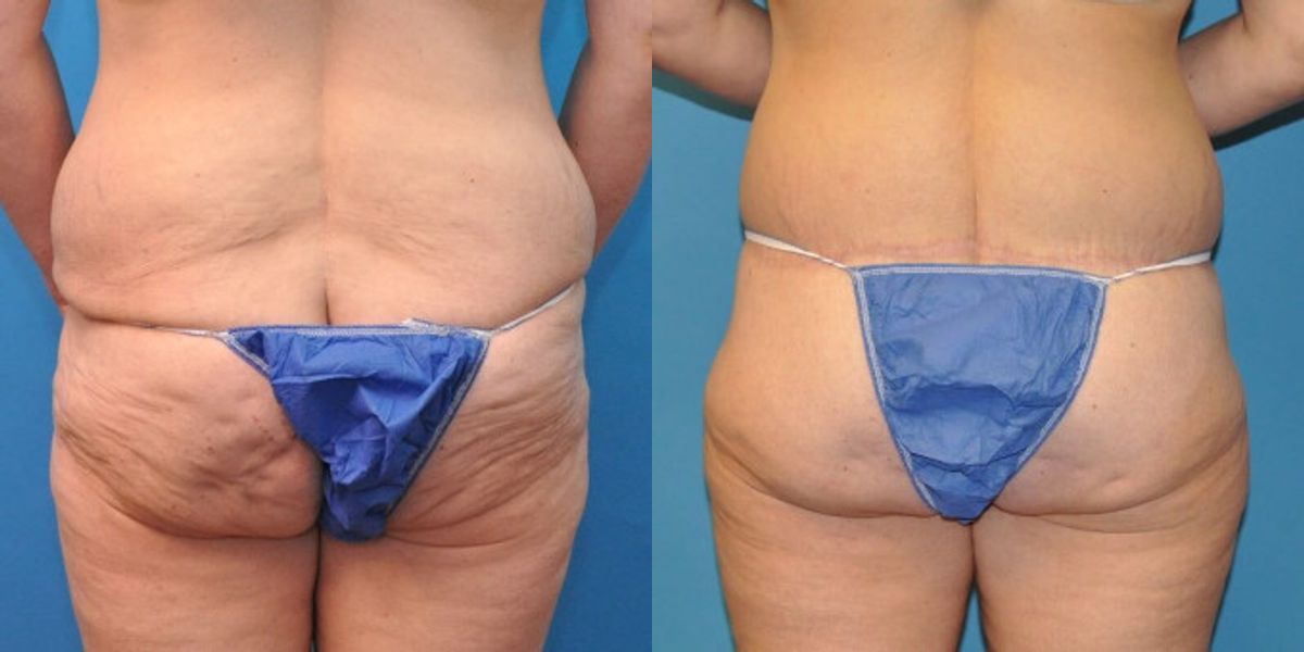 Lower Body Lift #4 - Before and After