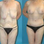 Lower Body Lift #5 - Before and After