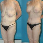Lower Body Lift #5 - Before and After