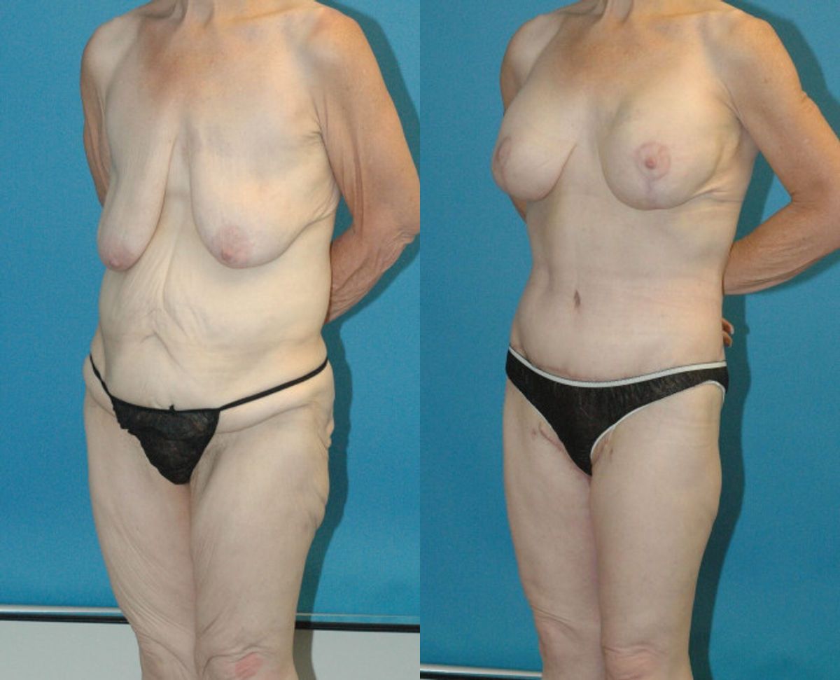 Lower Body Lift #5 - Before and After