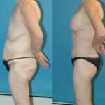 Lower Body Lift #5 - Before and After