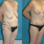 Lower Body Lift #5 - Before and After