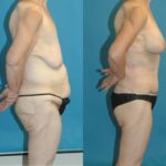 Lower Body Lift #5 - Before and After