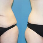 Lower Body Lift #6 - Before and After