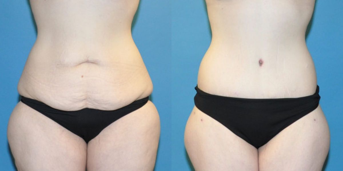Lower Body Lift #6 - Before and After