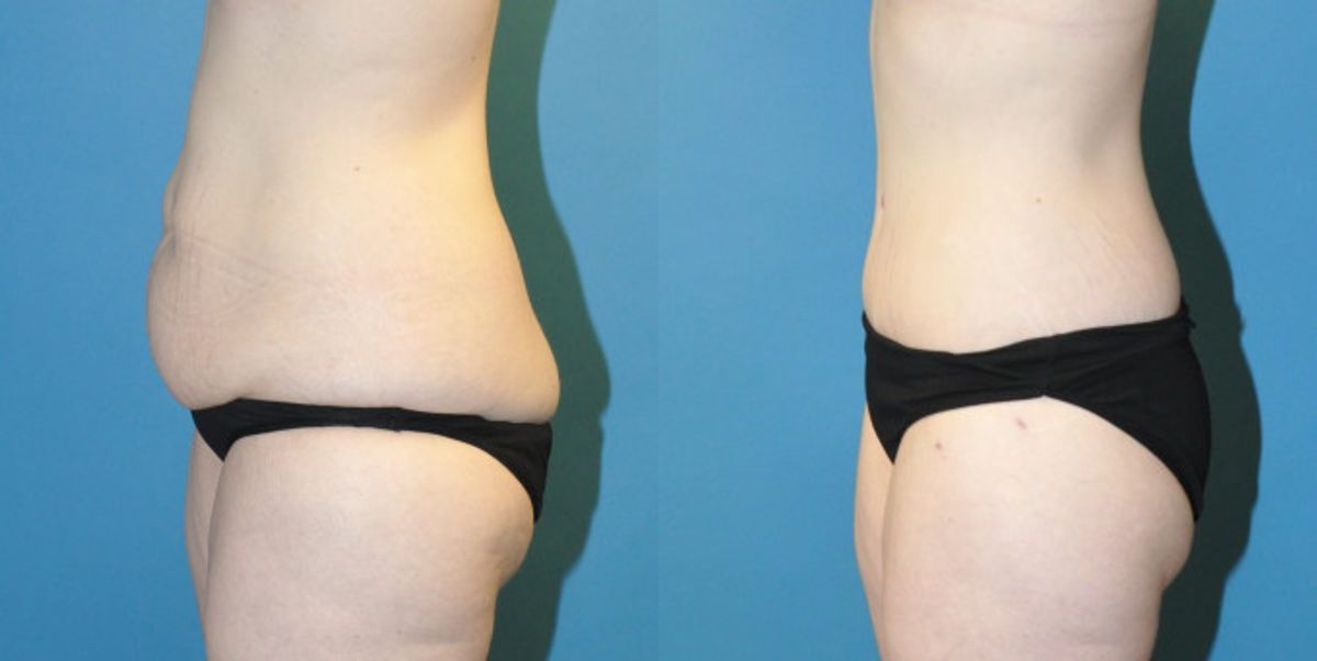 Lower Body Lift #6 - Before and After