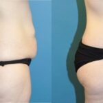 Lower Body Lift #6 - Before and After