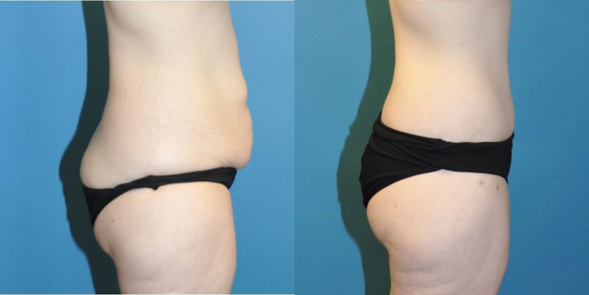 Lower Body Lift #6 - Before and After