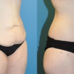 Lower Body Lift #6 - Before and After