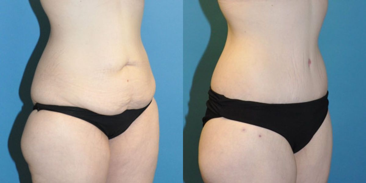 Lower Body Lift #6 - Before and After