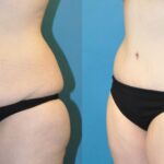 Lower Body Lift #6 - Before and After