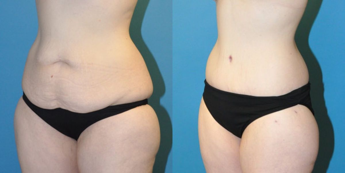 Lower Body Lift #6 - Before and After