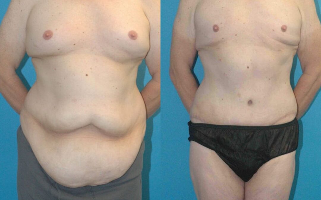 Lower Body Lift #7