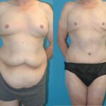 Lower Body Lift #7 - Before and After