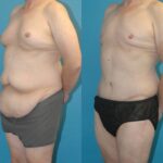 Lower Body Lift #7 - Before and After